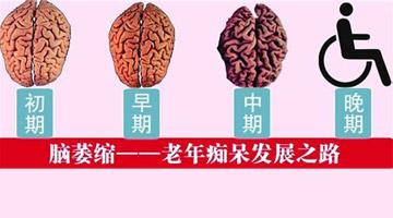 患脑萎缩的常见临床表现有什么