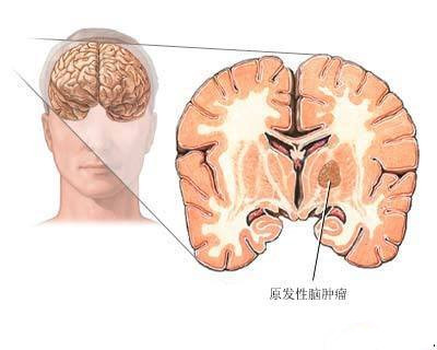 经颅磁刺激仪的功效_羊癫疯是什么原因得的 