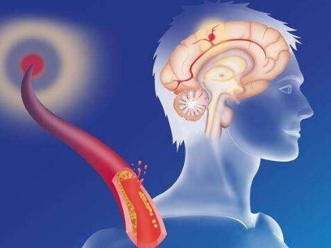 家用的经颅磁治疗仪_脑血栓多久能恢复正常 