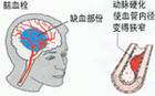 买一台经颅磁刺激仪多少钱?脑血栓如何预防复发 