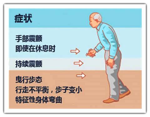 择思达斯家庭用经颅磁_帕金森走路的样子?