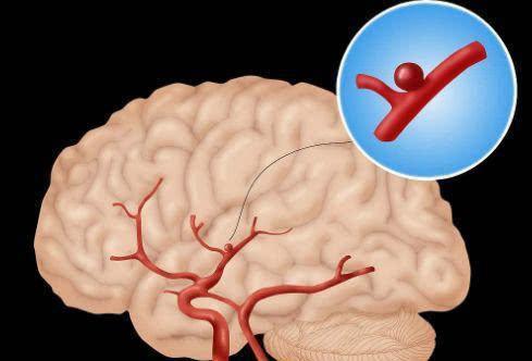 择思达斯经颅磁 癫痫病为什么会影响患者的智力?