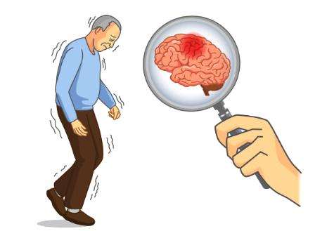 经颅磁治疗仪价格_帕金森病怎么防止发生呢