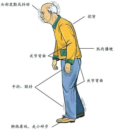 经颅磁治疗帕金森有用吗 