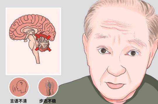 rTMS经颅磁刺激治疗仪|老人有脑萎缩怎么护理
