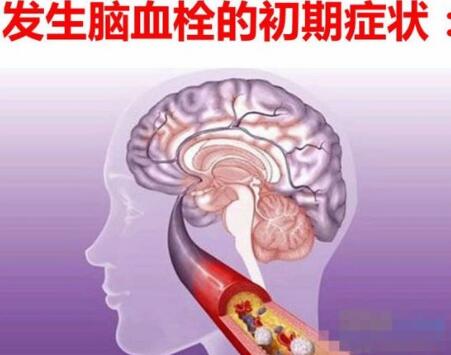 rtms经颅磁治疗仪|有脑血栓的人注意哪些