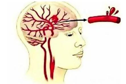 择思达斯磁疗_脑出血的常见并发症及处理方法